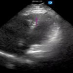 Saddle Pulmonary Embolus 4 Creative Commons images