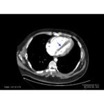 Saddle Pulmonary Embolus 9 Creative Commons images