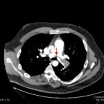Saddle Pulmonary Embolus 7 Creative Commons images