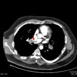 Saddle Pulmonary Embolus 8 Creative Commons images