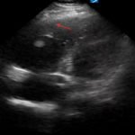 Saddle Pulmonary Embolus 3 Creative Commons images