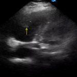 Saddle Pulmonary Embolus 5 Creative Commons images