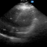 Saddle Pulmonary Embolus 2 Creative Commons images