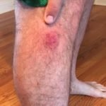 Brown Recluse Spider Bite 1 Creative Commons images