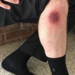 Brown Recluse Spider Bite 2 Creative Commons images