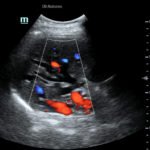 Point-of-Care Ultrasound to Evaluate Intrahepatic Biliary Stent Function 2 Creative Commons images