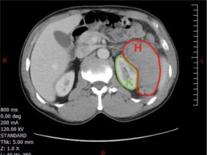 FAST Exam to Diagnose Subcapsular Renal Hematoma 3 Creative Commons images
