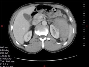 FAST Exam to Diagnose Subcapsular Renal Hematoma 6 Creative Commons images