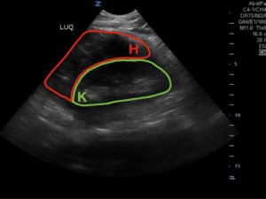 FAST Exam to Diagnose Subcapsular Renal Hematoma 2 Creative Commons images