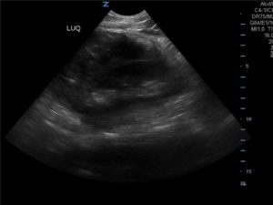 FAST Exam to Diagnose Subcapsular Renal Hematoma 5 Creative Commons images
