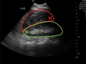 FAST Exam to Diagnose Subcapsular Renal Hematoma 1 Creative Commons images