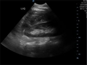 FAST Exam to Diagnose Subcapsular Renal Hematoma 4 Creative Commons images