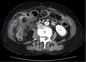 Incarcerated Ventral Hernia of T-colon Resulting in Colon Perforation and Intraabdominal Abscess 2 Creative Commons images