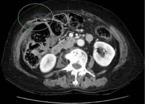 Incarcerated Ventral Hernia of T-colon Resulting in Colon Perforation and Intraabdominal Abscess 3 Creative Commons images