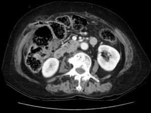 Incarcerated Ventral Hernia of T-colon Resulting in Colon Perforation and Intraabdominal Abscess 6 Creative Commons images