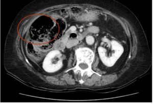 Incarcerated Ventral Hernia of T-colon Resulting in Colon Perforation and Intraabdominal Abscess 1 Creative Commons images