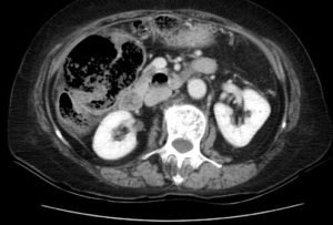 Incarcerated Ventral Hernia of T-colon Resulting in Colon Perforation and Intraabdominal Abscess 5 Creative Commons images