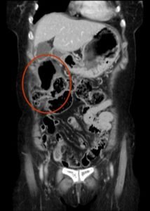 Incarcerated Ventral Hernia of T-colon Resulting in Colon Perforation and Intraabdominal Abscess 4 Creative Commons images