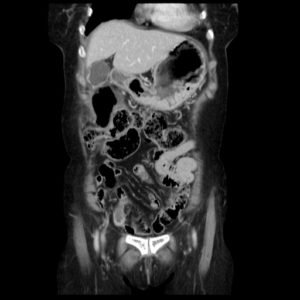 Incarcerated Ventral Hernia of T-colon Resulting in Colon Perforation and Intraabdominal Abscess 7 Creative Commons images