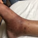 Henoch-Schönlein Purpura in the Adult 1 Creative Commons images