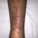 Henoch-Schönlein Purpura in the Adult 2 Creative Commons images