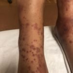 Henoch-Schönlein Purpura in the Adult 3 Creative Commons images