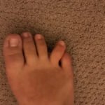 Digital Nerve Block for the Reduction of a Proximal Phalanx Fracture of the Foot – a Case Report 1 Creative Commons images