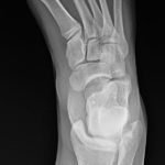Digital Nerve Block for the Reduction of a Proximal Phalanx Fracture of the Foot – a Case Report 3 Creative Commons images