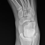 Digital Nerve Block for the Reduction of a Proximal Phalanx Fracture of the Foot – a Case Report 2 Creative Commons images
