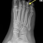 Digital Nerve Block for the Reduction of a Proximal Phalanx Fracture of the Foot – a Case Report 5 Creative Commons images