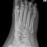 Digital Nerve Block for the Reduction of a Proximal Phalanx Fracture of the Foot – a Case Report 4 Creative Commons images