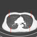 A Case Report on Miliary Tuberculosis in Acute Immune Reconstitution Inflammatory Syndrome 2 Creative Commons images