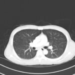 A Case Report on Miliary Tuberculosis in Acute Immune Reconstitution Inflammatory Syndrome 1 Creative Commons images