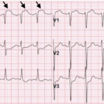 Post-Coital Sudden Cardiac Arrest Due to Non-Traumatic Subarachnoid Hemorrhage—A Case Report 2 Creative Commons images