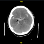 Post-Coital Sudden Cardiac Arrest Due to Non-Traumatic Subarachnoid Hemorrhage—A Case Report 1 Creative Commons images