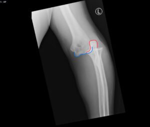 DRUJ Elbow Xray, AP, Annotated. JETem 2020