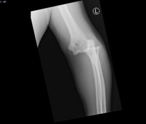 DRUJ Elbow Xray, AP. Unannotated. JETem 2020