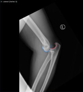 DRUJ Elbow Xray, Lateral, Annotated. JETem 2020