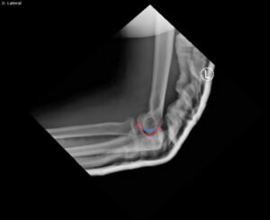 DRUJ Elbow Xray, Lateral, Post Reduction, Annotated. JETem 2020