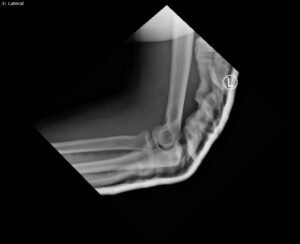 DRUJ Elbow Xray, Lateral, Post Reduction. Unannotated. JETem 2020