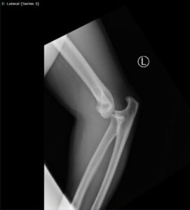 DRUJ Elbow Xray, Lateral. Unannotated. JETem 2020