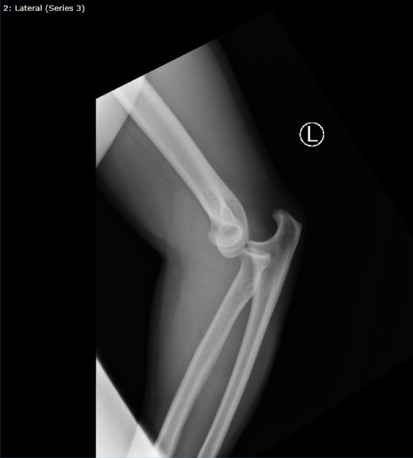 DRUJ Elbow Xray, Lateral. Unannotated. JETem 2020