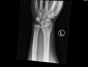 DRUJ Wrist Xray, AP. Unannotated. JETem 2020