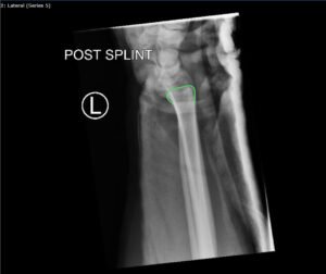 DRUJ Wrist Xray, Lateral, Post Reduction, Annotated. JETem 2020