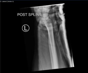 DRUJ Wrist Xray, Lateral, Post Reduction. Unannotated. JETem 2020