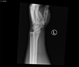 DRUJ Wrist Xray, Lateral. Unannotated. JETem 2020
