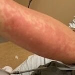 Case Report of COVID-19 Positive Male with Late-Onset Full Body Maculopapular Rash 2 Creative Commons images