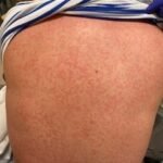 Case Report of COVID-19 Positive Male with Late-Onset Full Body Maculopapular Rash 1 Creative Commons images