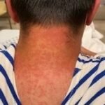Case Report of COVID-19 Positive Male with Late-Onset Full Body Maculopapular Rash 4 Creative Commons images