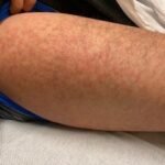 Case Report of COVID-19 Positive Male with Late-Onset Full Body Maculopapular Rash 3 Creative Commons images